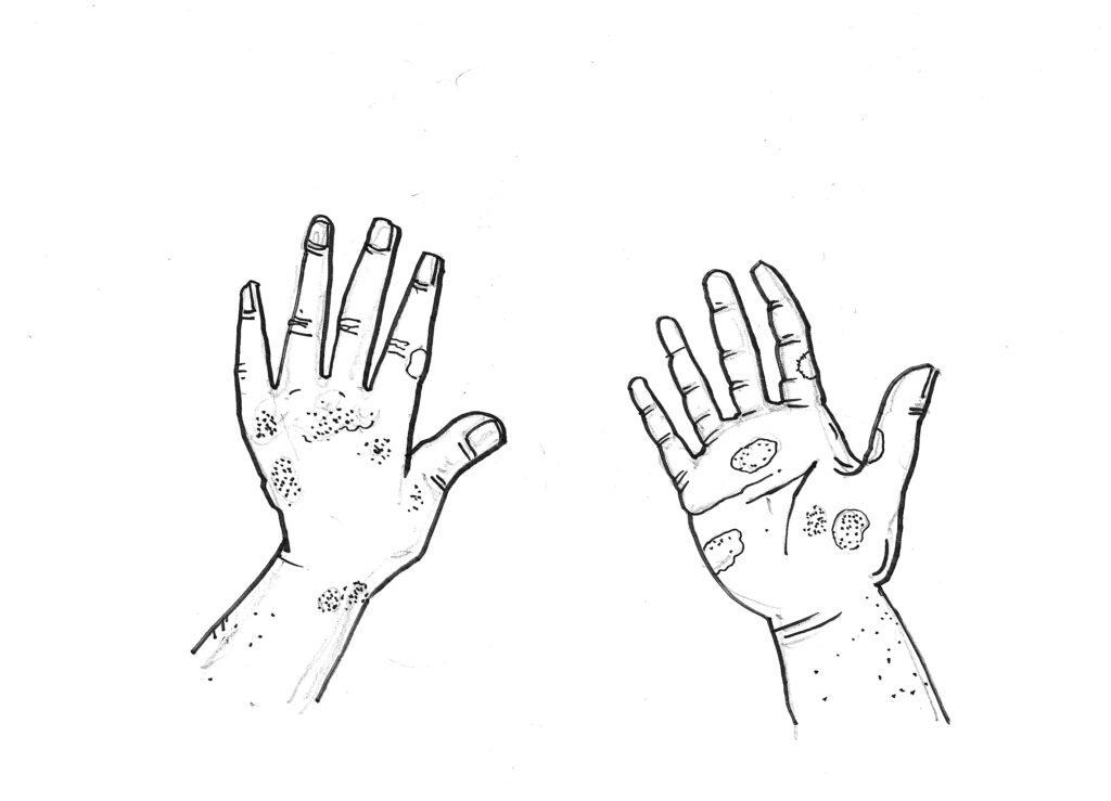 Illustration of blisters on a child's hands